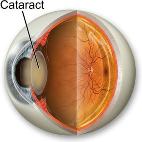 cataract.jpg